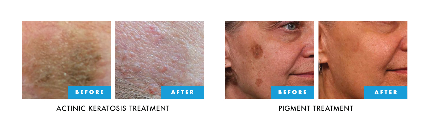 cryotherapy-1